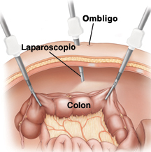 Colostomia laparoscopica.jpg