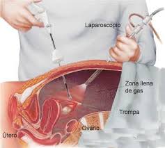 Colostomia laparoscopica 2.jpg