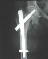 Femoral-GAMMA-xray.jpg